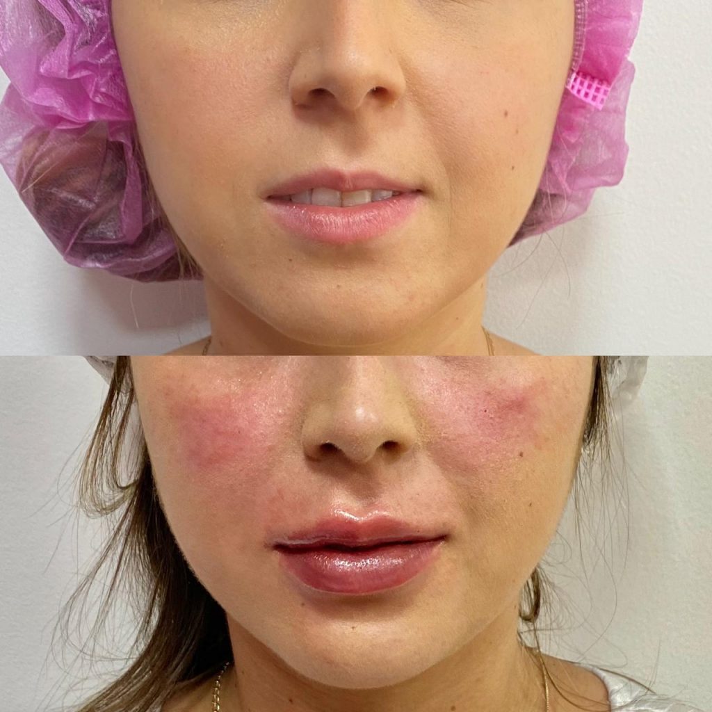 antes e depois de preenchimento labial em BH