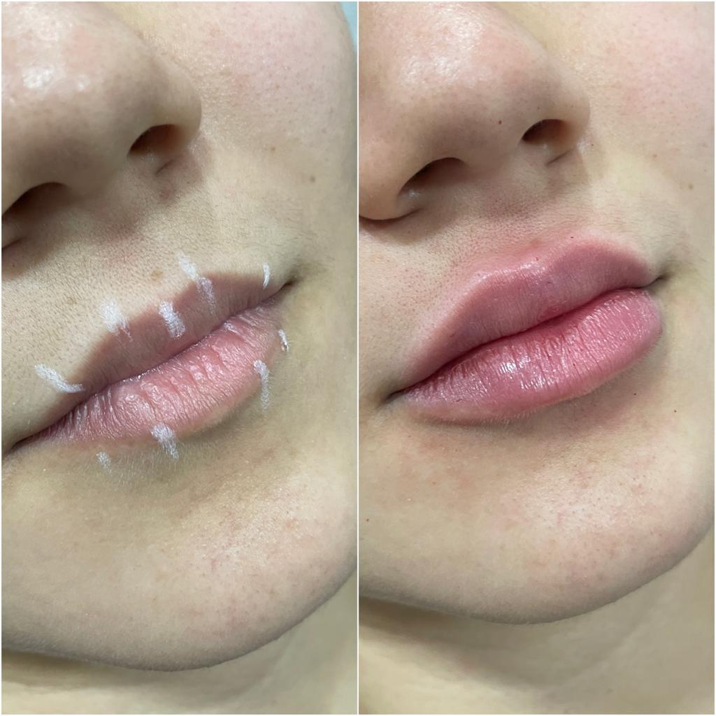 antes e depois preenchimento labial em Belo Horizonte