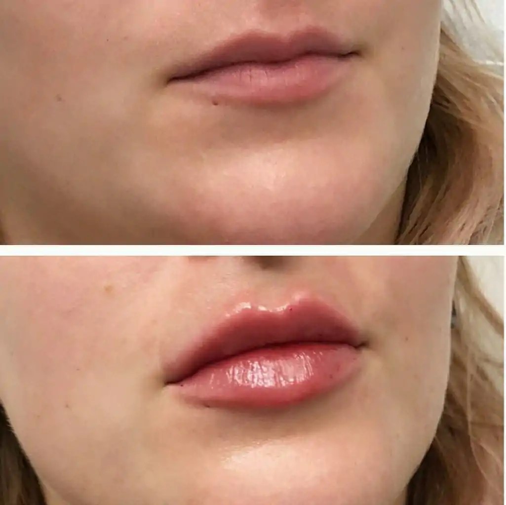 preenchimento labial antes e depois BH