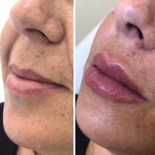 preenchimento labial antes e depois em BH