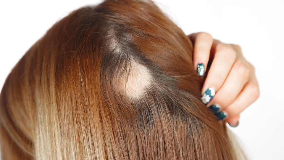como se prevenir da alopecia e tratar a queda de cabelo em BH